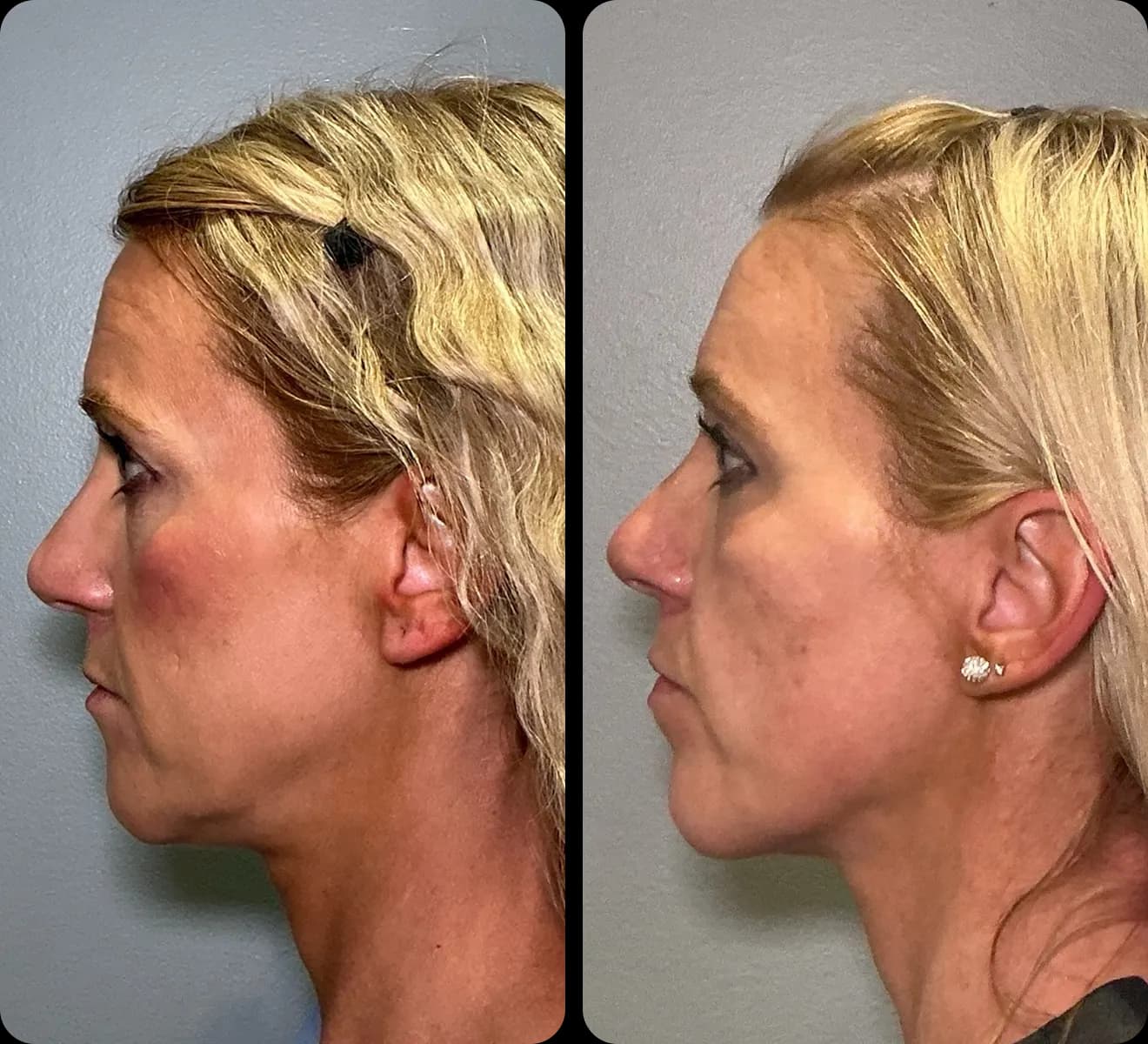 Side-by-side profile photos of a jawline and neck after two skin-tightening treatments
