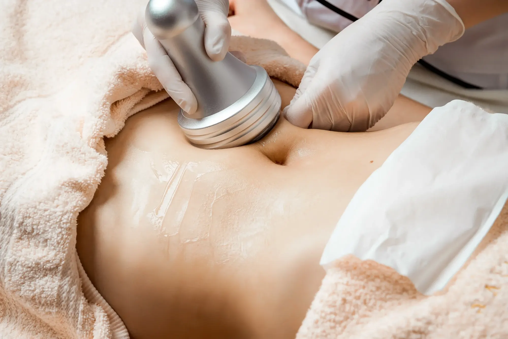 Close view of an Artemis T-Shape treatment on the abdomen