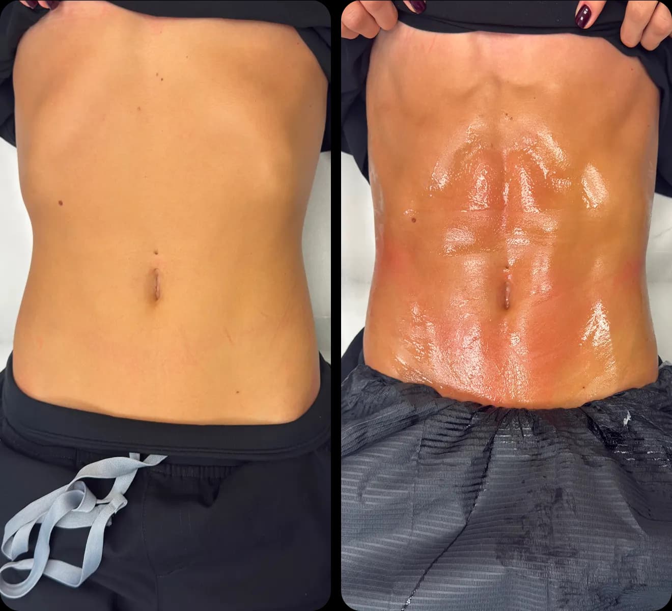 Side-by-side abdomen photos after eleven skin-tightening treatments